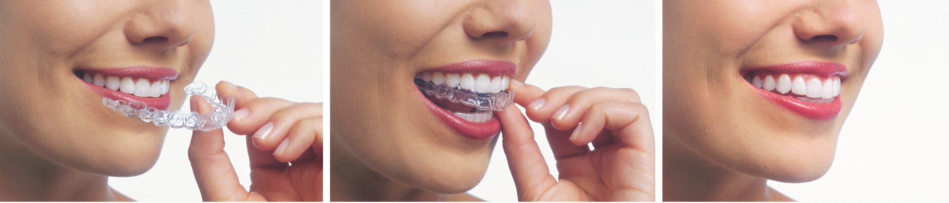 invisalign