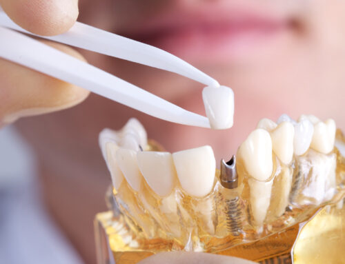 What To Expect After Getting A Dental Implant