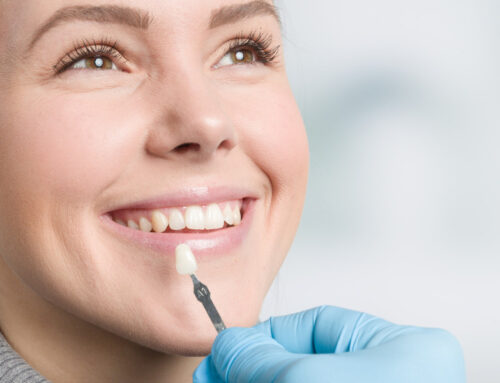 Why Veneers Are a Wise Choice