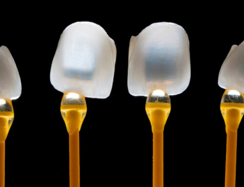The Functional Benefits of Dental Veneers