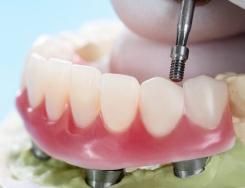 How to Ensure a Quick and Easy Dental Implant Recovery