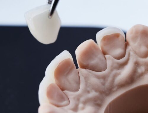Veneer Came Loose? Don’t Panic — Follow These Simple Steps