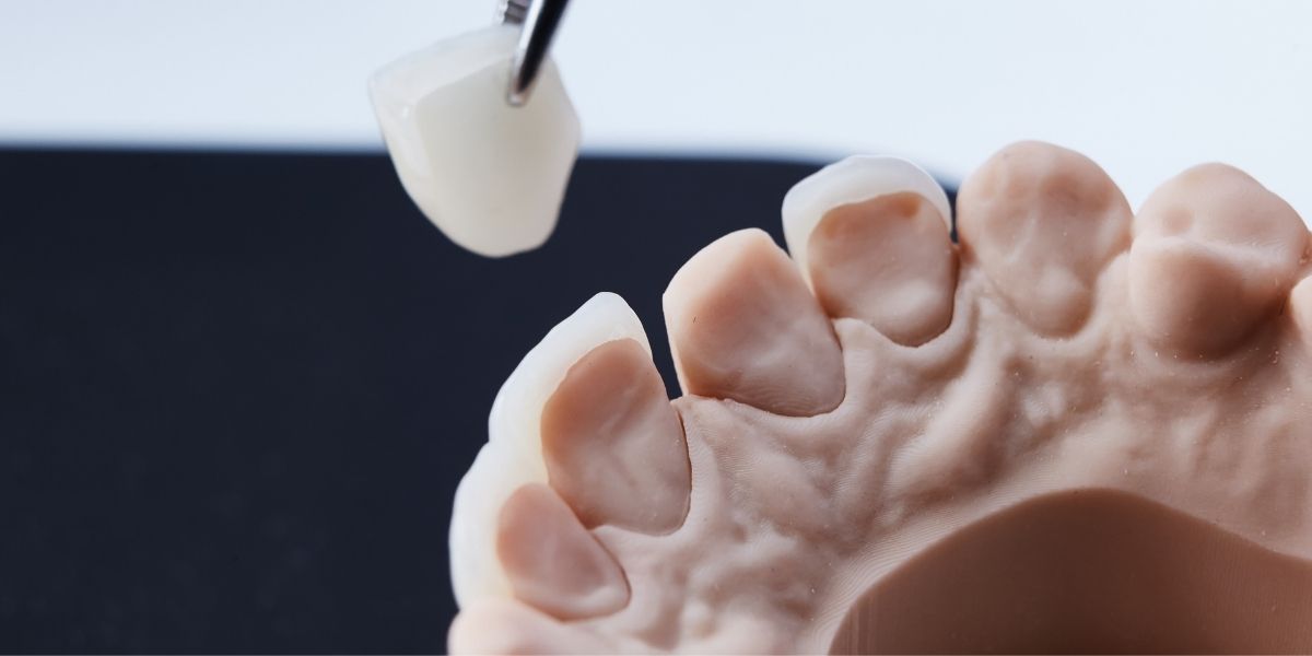 veneers in Herndon, VA