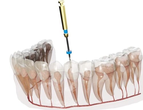 Afraid of a Root Canal? Read This Before You Panic