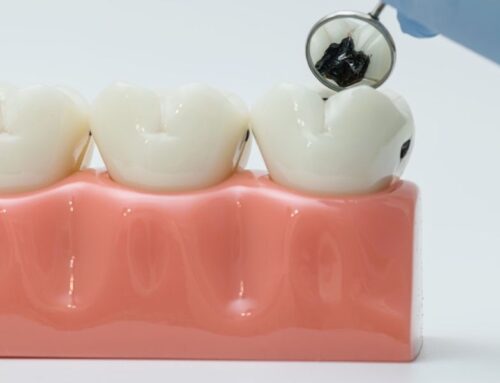 Tooth Decay or Chipped Tooth? Here’s How Dental Fillings Can Restore Your Smile