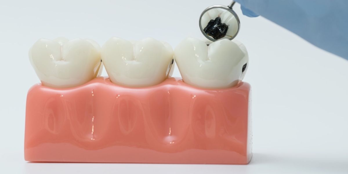 tooth decay model in Herndon VA