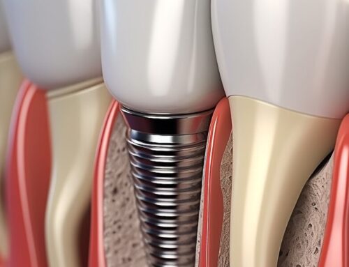 Can You Be Allergic to Dental Implants?