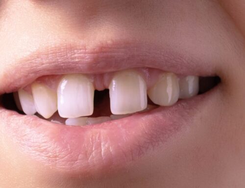Cracked, Chipped, or Gapped Teeth? Tooth Bonding in Herndon, VA Can Help