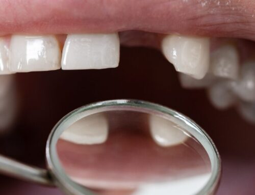 Missing Teeth Ruining Your Confidence? Dental Implants Can Change Everything