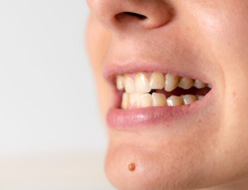 Why Your Teeth Aren’t White Anymore And How to Fix It Fast